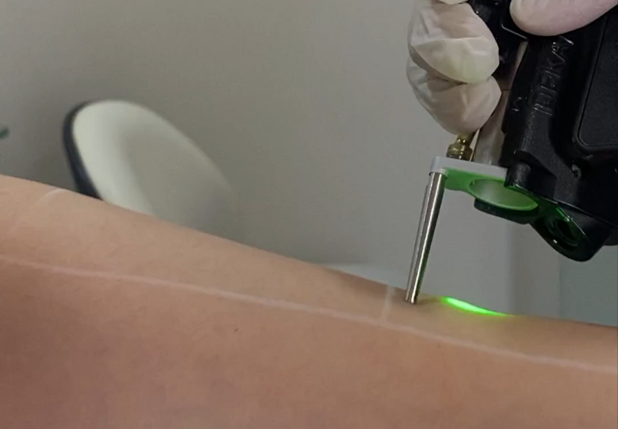 Laser Hair Removal